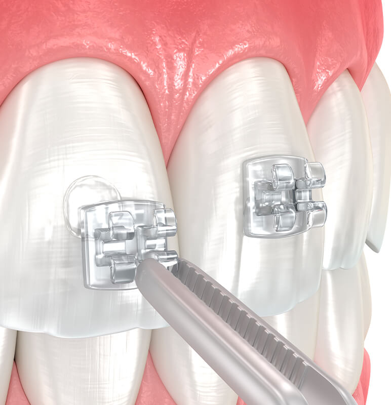 How do braces work?